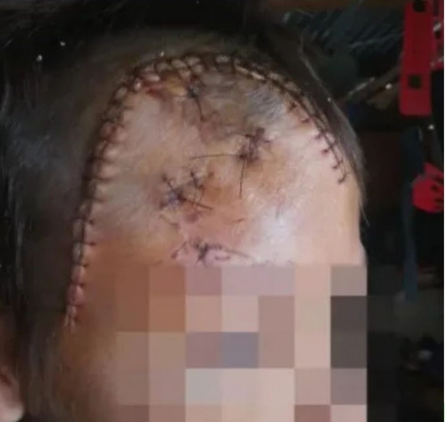 BRUTAL AGRESIÓN A UN NIÑO: “TUVIERON QUE HACERLE 50 PUNTOS EN LA CABEZA”